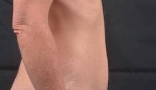 Abdominoplasty Before & After Gallery - Patient 393770 - Image 4