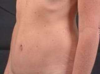 Abdominoplasty Before & After Gallery - Patient 393770 - Image 6