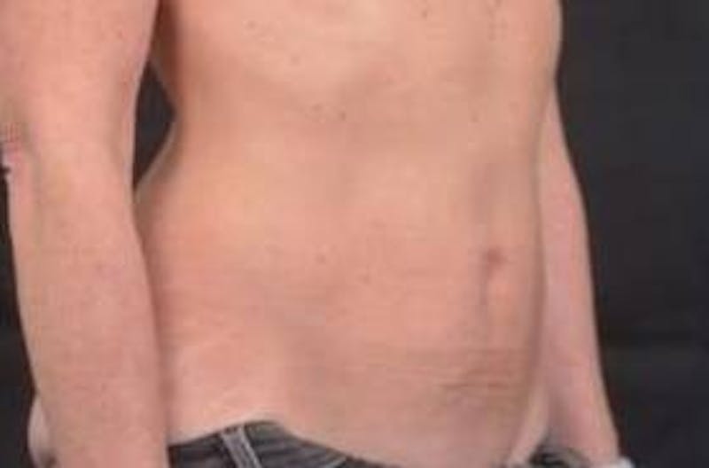 Abdominoplasty Before & After Gallery - Patient 393770 - Image 7