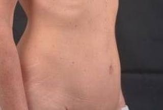 Abdominoplasty Before & After Gallery - Patient 393770 - Image 8