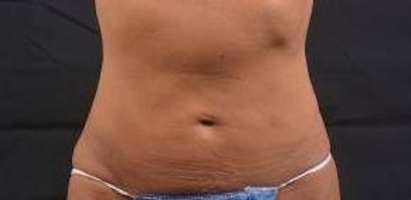 Abdominoplasty Before & After Gallery - Patient 159782 - Image 1