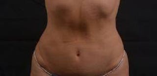 Abdominoplasty Before & After Gallery - Patient 159782 - Image 2