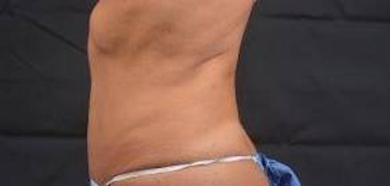 Abdominoplasty Before & After Gallery - Patient 159782 - Image 3