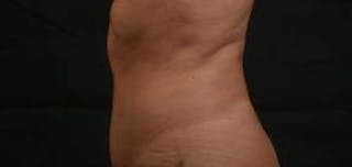 Abdominoplasty Before & After Gallery - Patient 159782 - Image 4
