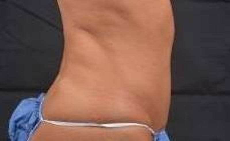 Abdominoplasty Before & After Gallery - Patient 159782 - Image 5