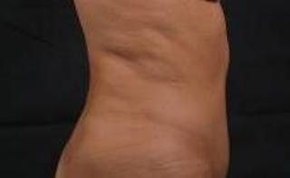 Abdominoplasty Before & After Gallery - Patient 159782 - Image 6