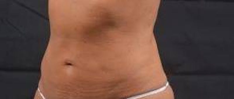Abdominoplasty Before & After Gallery - Patient 159782 - Image 7