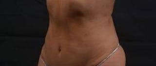 Abdominoplasty Before & After Gallery - Patient 159782 - Image 8