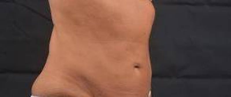 Abdominoplasty Before & After Gallery - Patient 159782 - Image 9