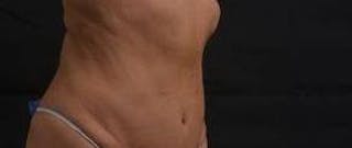 Abdominoplasty Before & After Gallery - Patient 159782 - Image 10