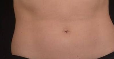 BodyTite Before & After Gallery - Patient 364036 - Image 1
