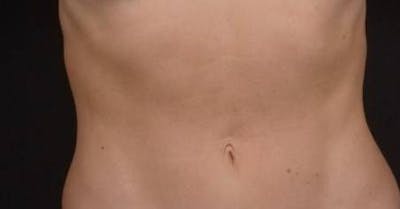 BodyTite Before & After Gallery - Patient 364036 - Image 2