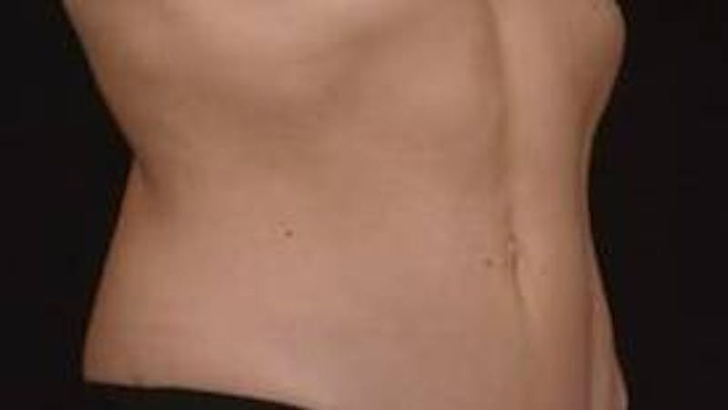BodyTite Before & After Gallery - Patient 364036 - Image 10