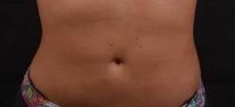 BodyTite Before & After Gallery - Patient 200608 - Image 2