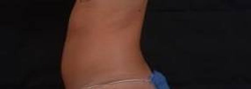 BodyTite Before & After Gallery - Patient 200608 - Image 3