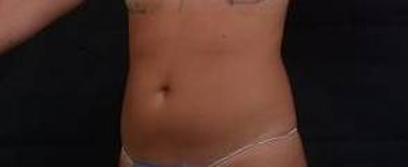 BodyTite Before & After Gallery - Patient 200608 - Image 7