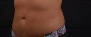 BodyTite Before & After Gallery - Patient 200608 - Image 8