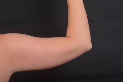 BodyTite Arms Before & After Gallery - Patient 936454 - Image 1