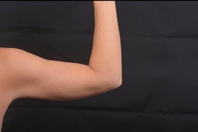 BodyTite Arms Before & After Gallery - Patient 936454 - Image 2
