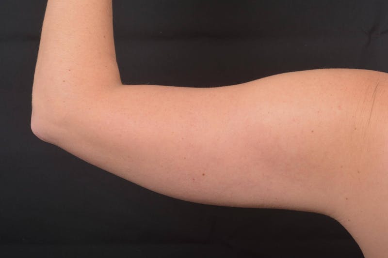 BodyTite Arms Before & After Gallery - Patient 936454 - Image 3