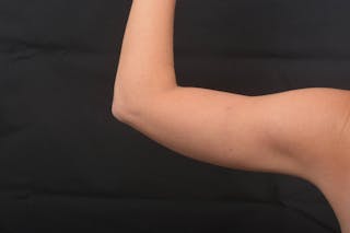 BodyTite Arms Before & After Gallery - Patient 936454 - Image 4