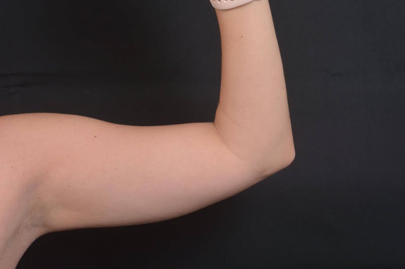 BodyTite Arms Before & After Gallery - Patient 936454 - Image 5