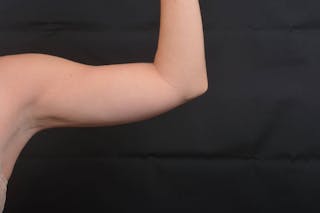 BodyTite Arms Before & After Gallery - Patient 936454 - Image 6