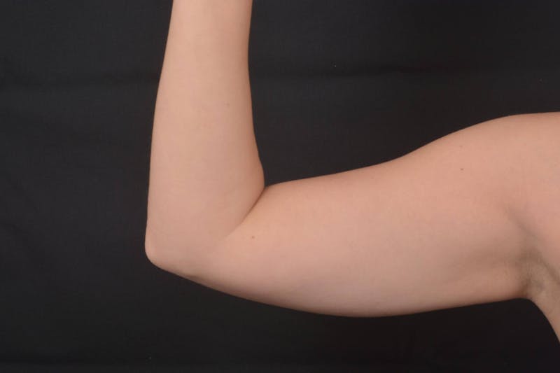 BodyTite Arms Before & After Gallery - Patient 936454 - Image 7