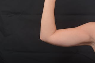 BodyTite Arms Before & After Gallery - Patient 936454 - Image 8