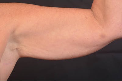 BodyTite Arms Before & After Gallery - Patient 263316 - Image 1