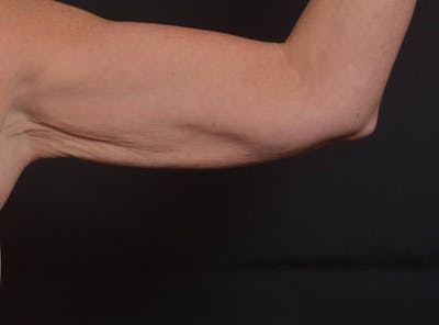BodyTite Arms Before & After Gallery - Patient 263316 - Image 2