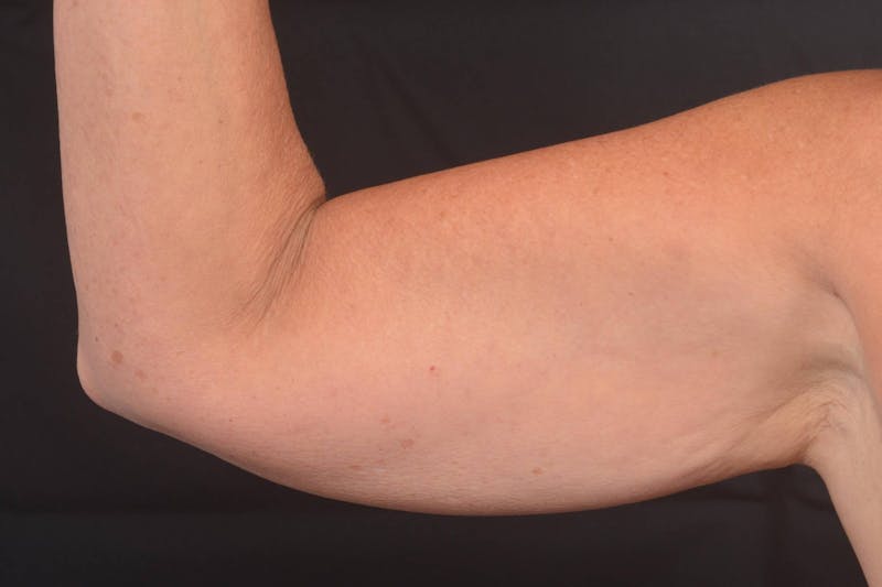 BodyTite Arms Before & After Gallery - Patient 263316 - Image 3