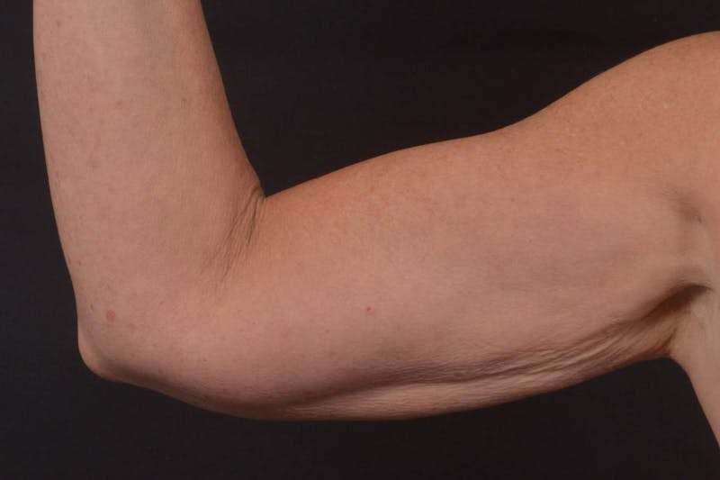 BodyTite Arms Before & After Gallery - Patient 263316 - Image 4