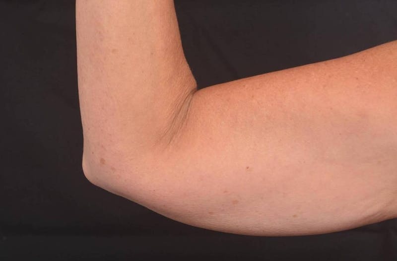 BodyTite Arms Before & After Gallery - Patient 263316 - Image 5