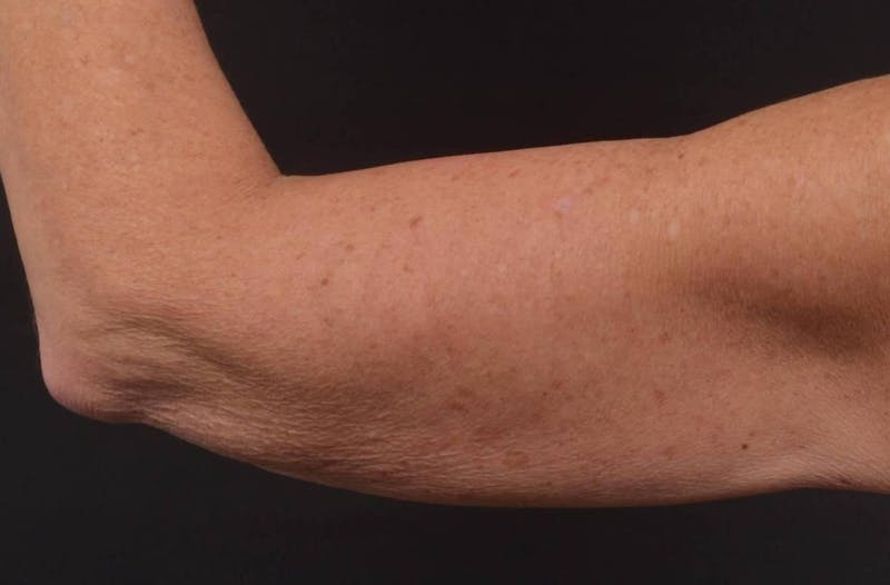 BodyTite Arms Before & After Gallery - Patient 263316 - Image 6