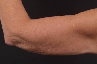 BodyTite Arms Before & After Gallery - Patient 263316 - Image 6