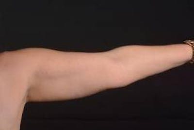 BodyTite Arms Before & After Gallery - Patient 400319 - Image 1