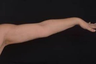 BodyTite Arms Before & After Gallery - Patient 400319 - Image 2