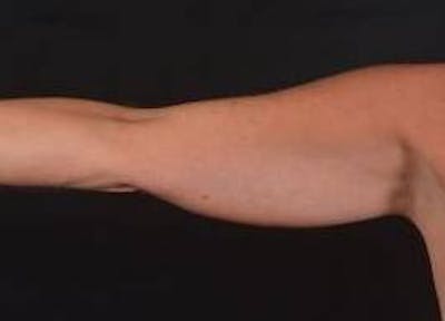 BodyTite Arms Before & After Gallery - Patient 386112 - Image 1