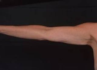 BodyTite Arms Before & After Gallery - Patient 386112 - Image 2