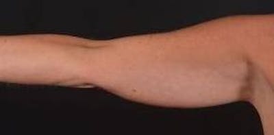 BodyTite Arms Before & After Gallery - Patient 223450 - Image 1