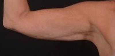 BodyTite Arms Before & After Gallery - Patient 223450 - Image 2