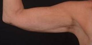 BodyTite Arms Before & After Gallery - Patient 223450 - Image 2