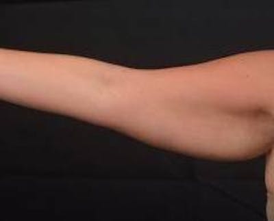 BodyTite Arms Before & After Gallery - Patient 430271 - Image 1