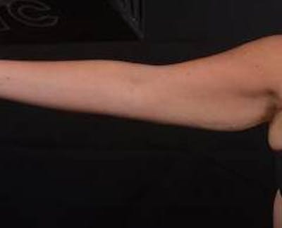BodyTite Arms Before & After Gallery - Patient 430271 - Image 2