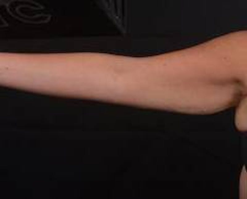 BodyTite Arms Before & After Gallery - Patient 430271 - Image 2