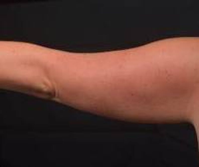 BodyTite Arms Before & After Gallery - Patient 430271 - Image 3