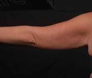 BodyTite Arms Before & After Gallery - Patient 430271 - Image 4
