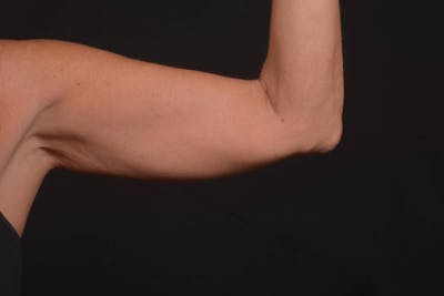 BodyTite Arms Before & After Gallery - Patient 595616 - Image 1