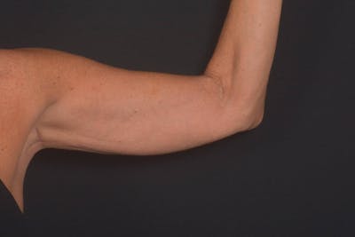 BodyTite Arms Before & After Gallery - Patient 595616 - Image 2